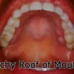 Itchy Roof of Mouth