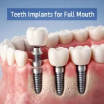 Modern dental animation showing full arch tooth replacement with implants embedded in gums, illustrating complete mouth implant restoration