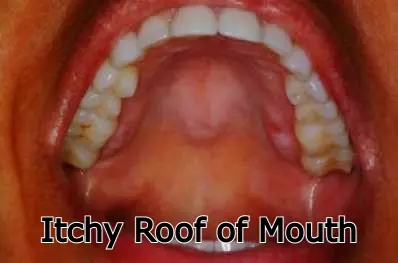 Itchy Roof of Mouth