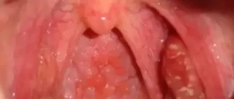 Blister in the back of throat