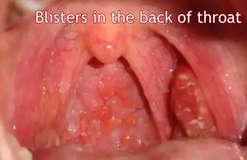 Blister in the back of throat