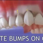 white bumps on gum