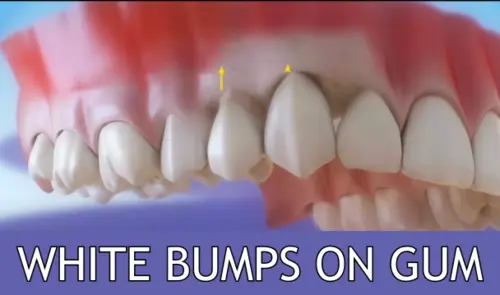 white bumps on gum