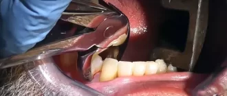 gum infection after tooth extraction