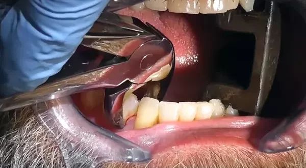 gum infection after tooth extraction