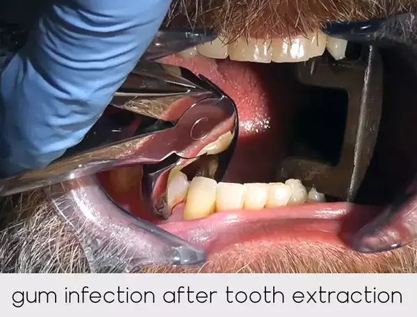 gum infection after tooth extraction