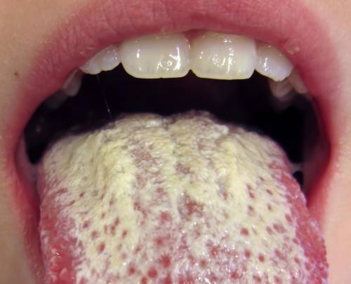 oral psoriasis