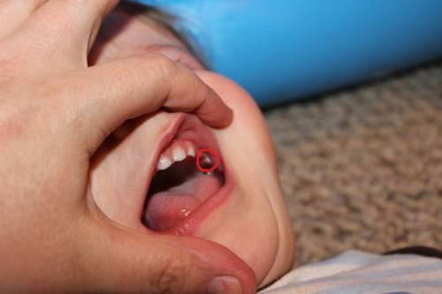 Tooth pain in small baby