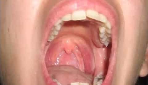 Woman has itchy roof of the mouth