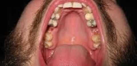 Roof of mouth itchness (in man)