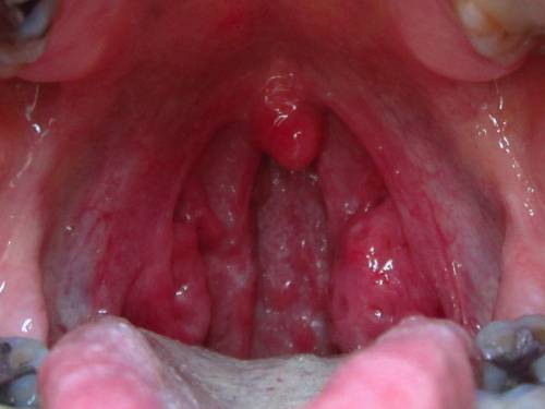 red bumps on back of tongue and sore throat