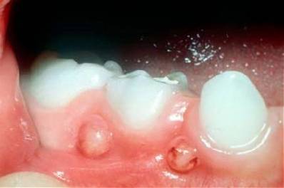 Abscessed Tooth Swelling Causes and Best Treatment