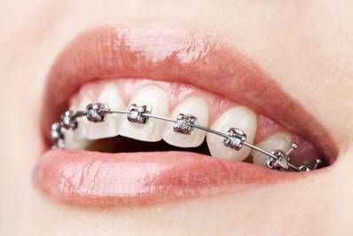 Affordable (Orthodontics) Braces for Adults