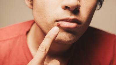 Best Over-the-Counter Medicines for Cold Sore Treatment