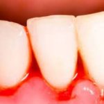 Bleeding Gums When Brushing