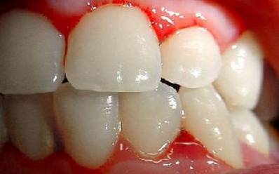 Bleeding Gums When Flossing