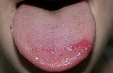 Burning Mouth Syndrome Causes, Symptoms and Treatment