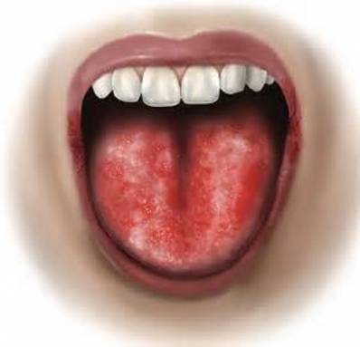 Burning Tongue Causes and Treatment