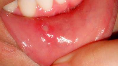 Canker Sore in Mouth Causes, Symptoms, Treatment