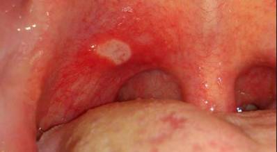 Canker Sore or Mouth Sore in My Throat
