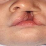 Causes of Cleft Lip and Palate