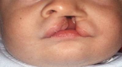 Causes of Cleft Lip and Palate