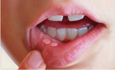 Cold Sores And Fever Blisters Causes and Remedies