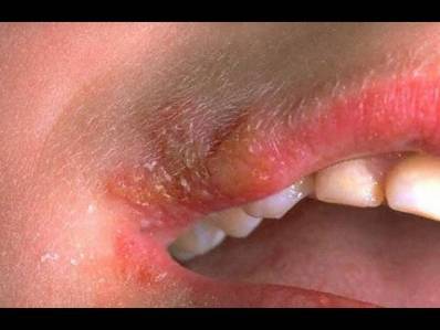 Cold Sores in Corner of Mouth