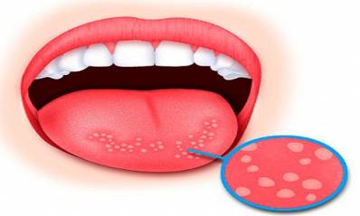 Cold Sores on Tongue