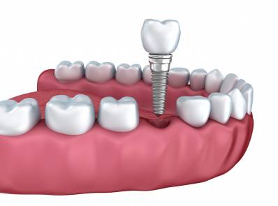 Cost for Dental Implant
