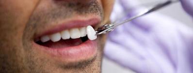 Dental Bonding Vs Composite Veneers Pros and Cost