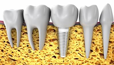 Dental Bone Graft Bone Augmentation for Implants