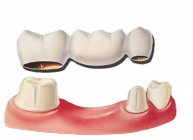 Dental Bridge vs. Implant What to Choose and Cost