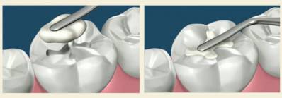 Dental Filling When You Need It, Pain Before and After, Replacing Filling