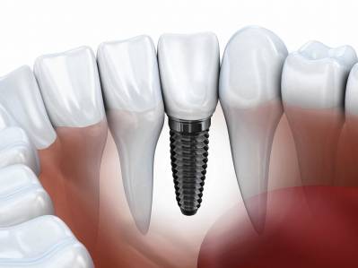 Dental Implant Infection