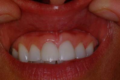 Early Signs Of Mouth Cancer_398x264