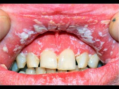 Fungus in Mouth (Oral Infection)