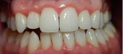 Gum Disease (Gingivitis) in Adults