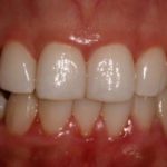 How to Get Rid of Swollen Gums