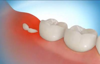 How to Stop Wisdom Tooth Pain
