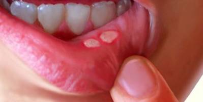 How to Treat Canker Sores