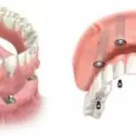 Implant-supported Denture
