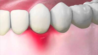 Inflamed Gums Causes and Remedies