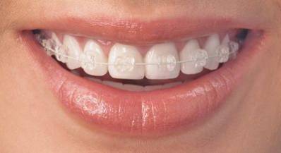 least expensive invisible braces