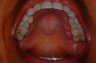 Itchy Roof Of Mouth Causes And Treatment Utodent