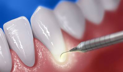 Laser Periodontal Therapy for Gum Treatment