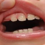 Molar Teething in Toddlers