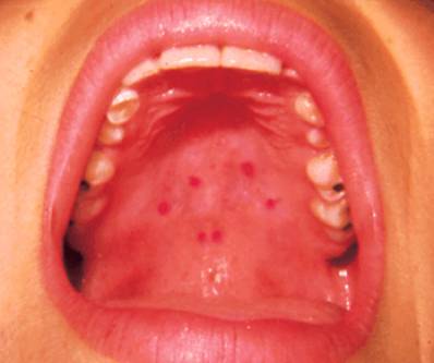 Red Spots on Roof of Mouth