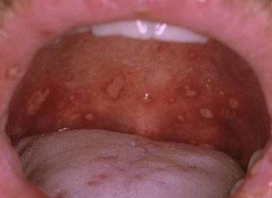 STDs in Mouth Symptoms and Prevention