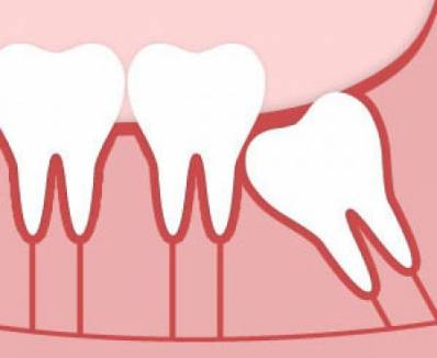 Wisdom Tooth